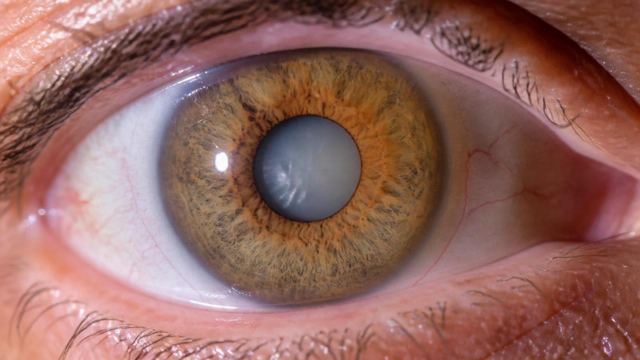 Ilustração de catarata: cristalino opaco e lente intraocular