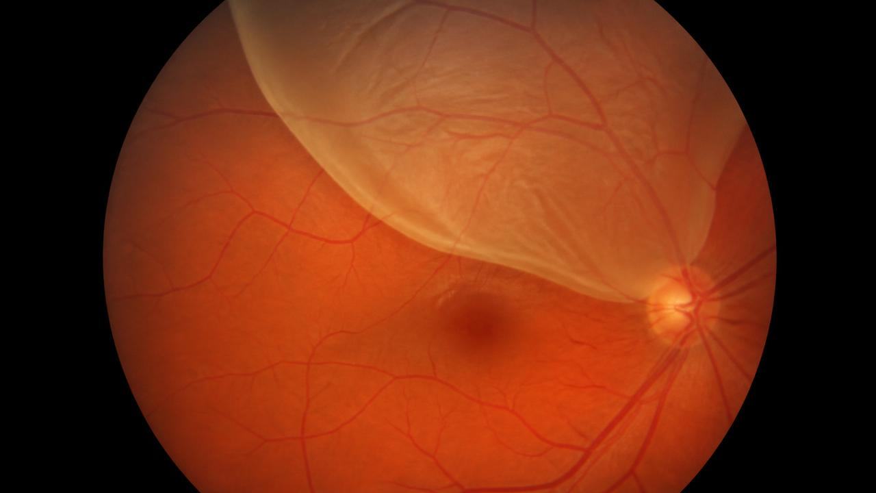 Ilustração de descolamento de retina